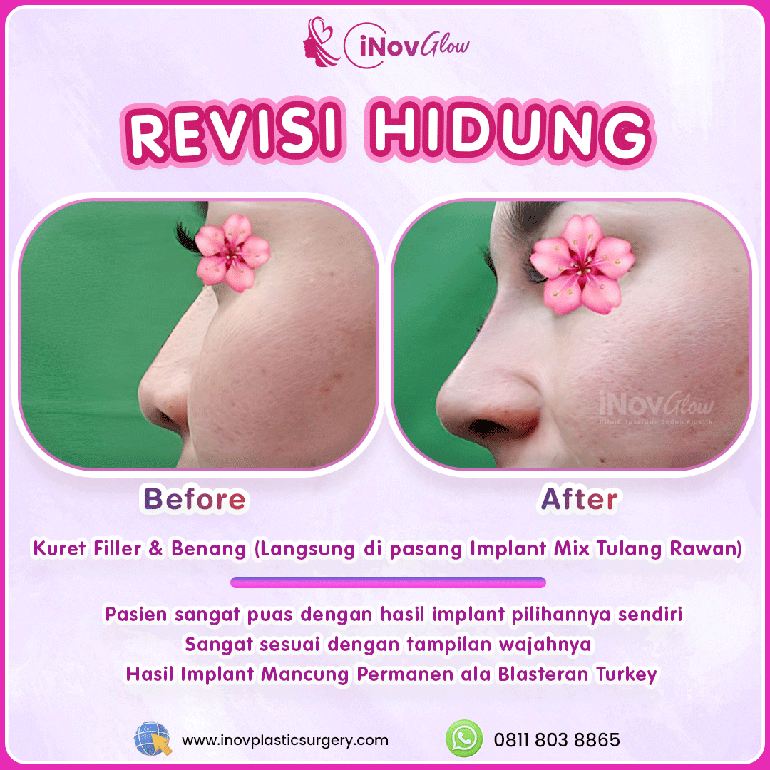 Revisi-Hidung-InovGlow-Feed-003.png