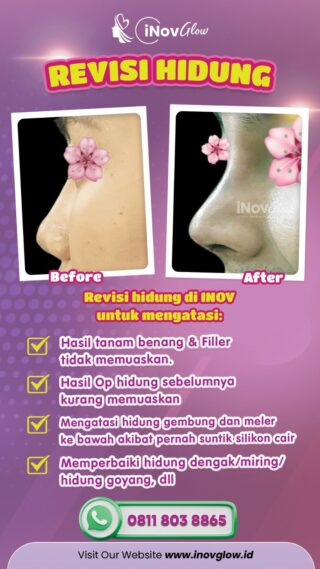 Operasi Revisi Hidung: Menemukan Dokter Bedah yang Tepat untuk Hasil Sempurna di Inov Glow