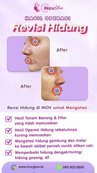 Pilihan Operasi Revisi Hidung untuk Hasil yang Lebih Sempurna di Inov Glow