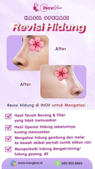 Mengatasi Kekecewaan Rhinoplasty dengan Operasi Revisi Hidung di Inov Glow
