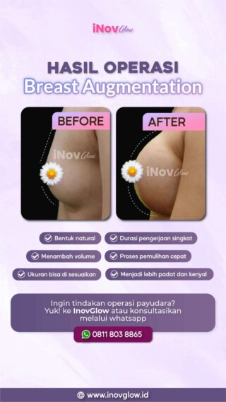 Membesarkan Payudara Cepat dan Permanen