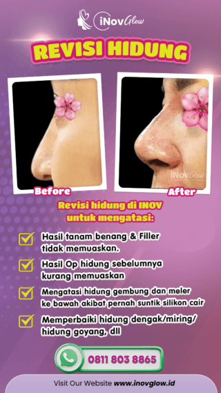 Mewujudkan Hidung Mancung dengan Rhinoplasty di Klinik Inov Glow