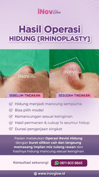 Operasi Hidung Mancung di Jakarta