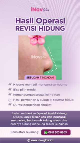 Perbaikan Hidung Profesional: Mengapa Operasi Revisi Bisa Menjadi Pilihan Anda di Klinik Inov Glow