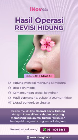 Perbaikan Hidung Profesional: Mengapa Operasi Revisi Bisa Menjadi Pilihan Anda di Klinik Inov Glow