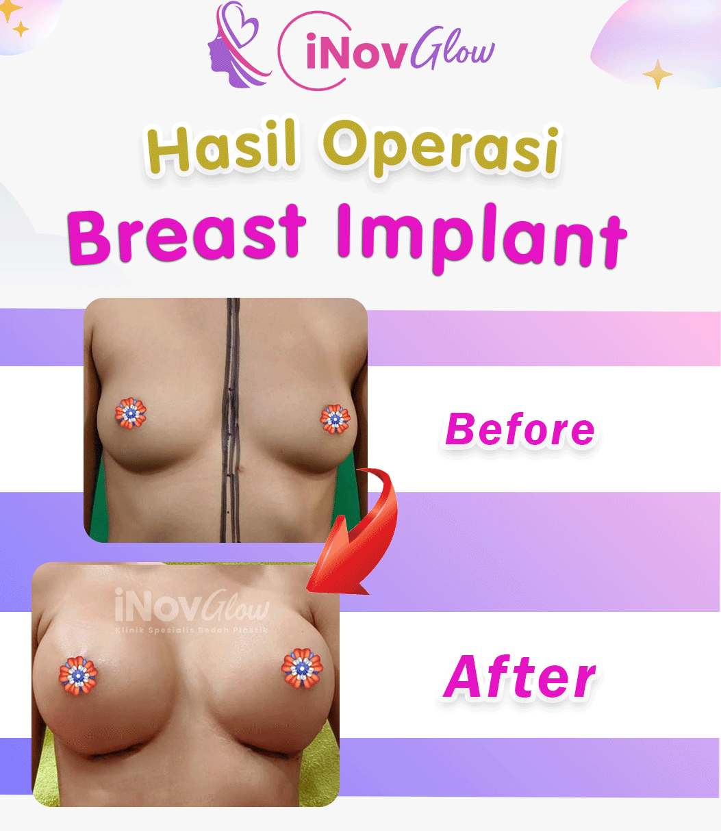 IGS-BA-InovGlow-Breast-Implant-003-3-fotor-20230811164734.jpg