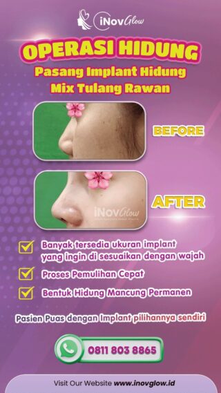 InovGlow Klinik Pilihan Rhinoplasty