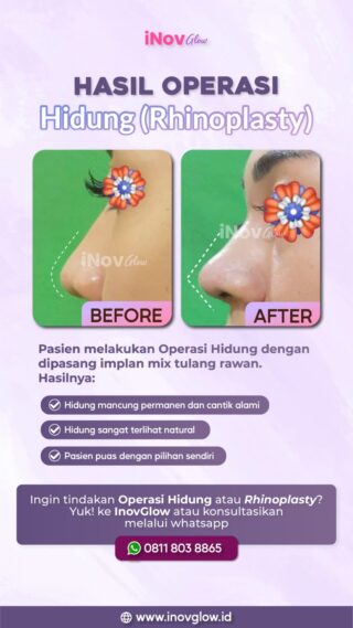 Mencari Rhinoplasty Terbaik? Pilihan Klinik Terpercaya