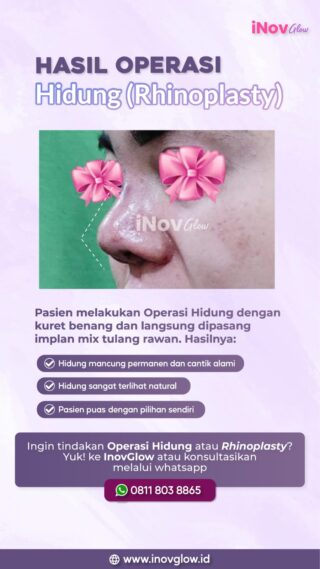 InovGlow Klinik Spesialis Rhinoplasty