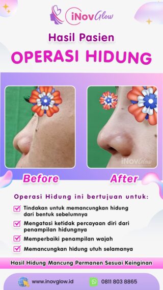 Operasi Hidung Mancung: Layanan Unggulan dari Inov Glow