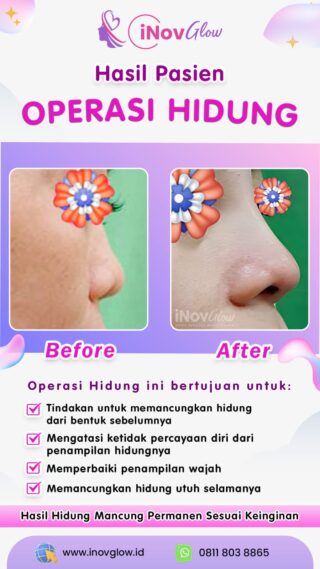 Mencari Rhinoplasty Terbaik? Pilihan Klinik Terpercaya