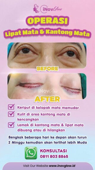 Keunggulan Operasi Lipatan Mata di Inov Glow
