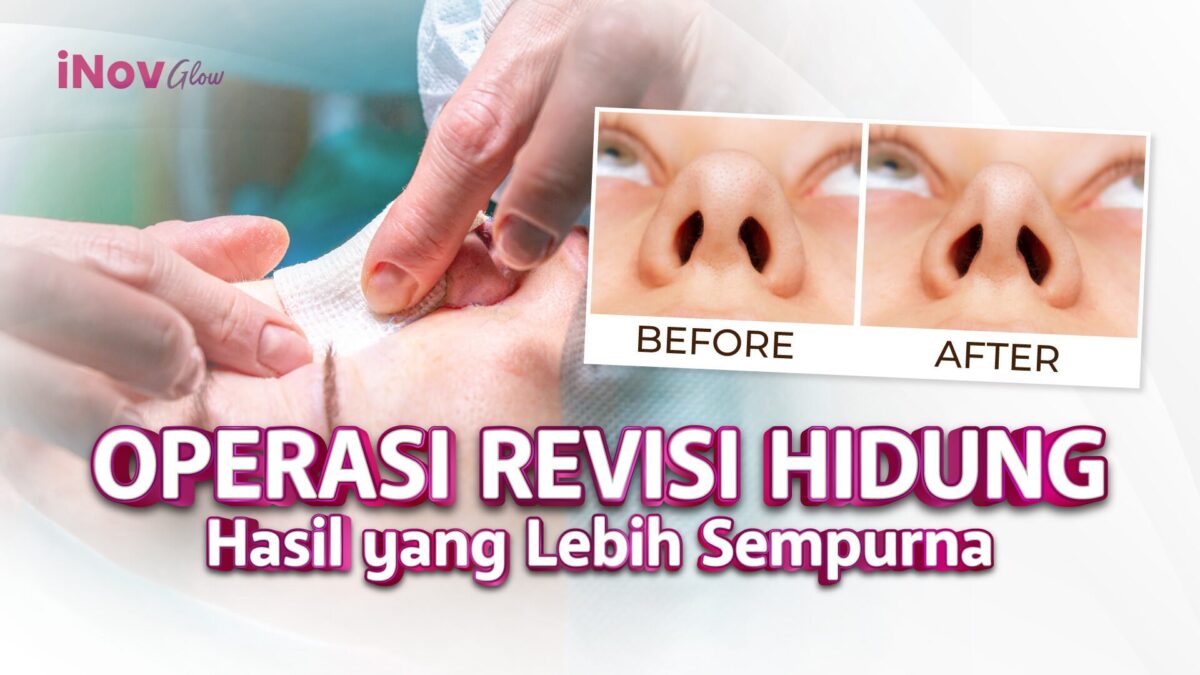 28-November_OP-REVISI-HIDUNG-HASIL-YANG-SEMPURNA-2-1200x675.jpg