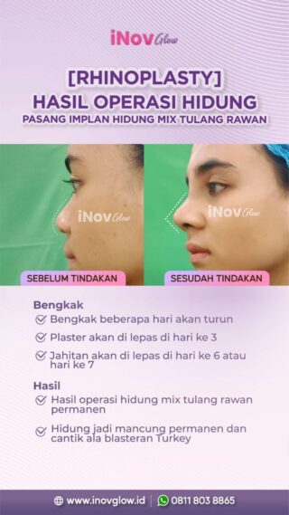 Rhinoplasty: Prosedur Operasi Hidung yang Dilakukan di Klinik Inov Glow Rhinoplasty: Prosedur Operasi Hidung yang Dilakukan di Klinik Inov Glow