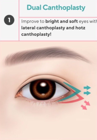 PROSEDUR CANTHOPLASTY