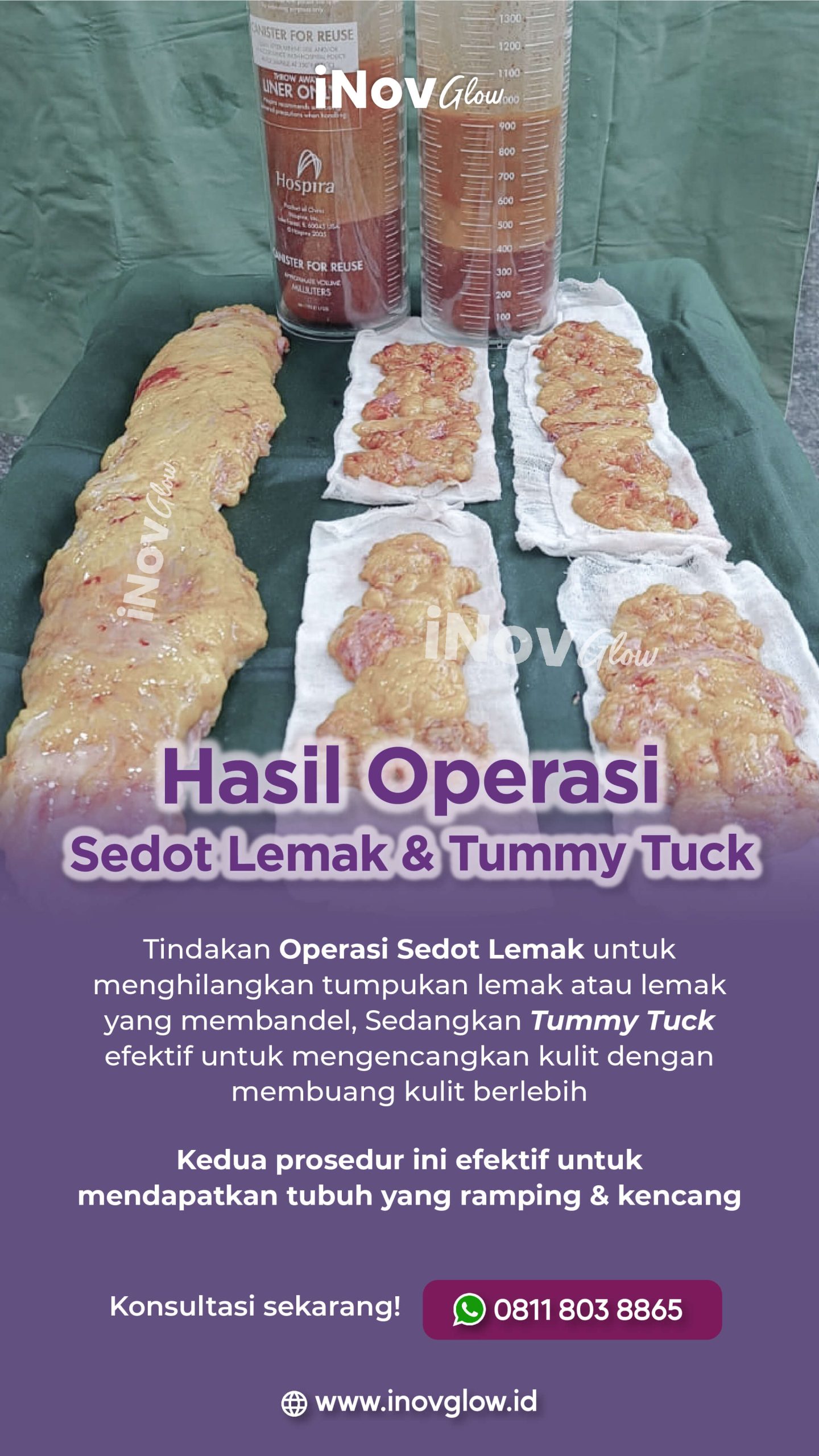 Hasil sedot lemak pasien Klinik Utama iNOV GLOW